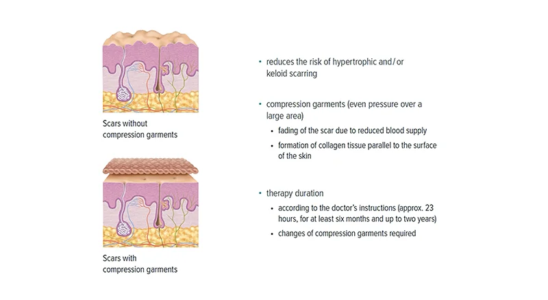 Skin layer showing the importance of scar management after surgery