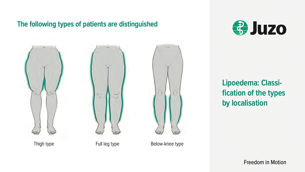 Three types of lipedema illustrated based on fat distribution: thigh type, full leg type, and below-knee type.